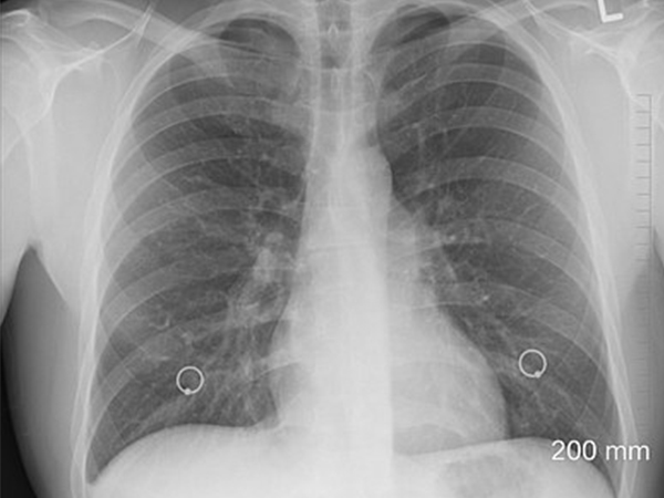 Bronchiectasis Bronchiectasis
