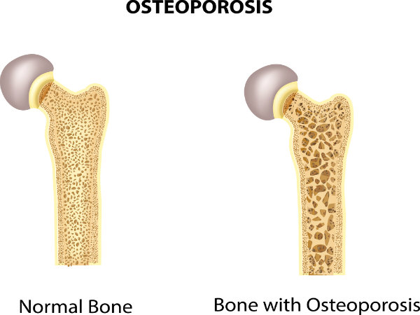 Osteoporosis