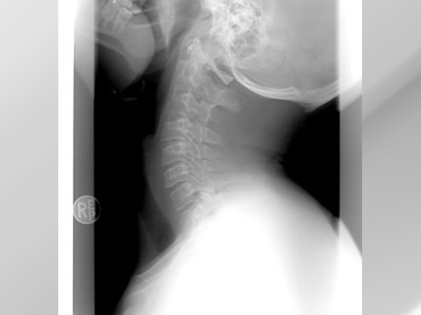 Spinal Stenosis