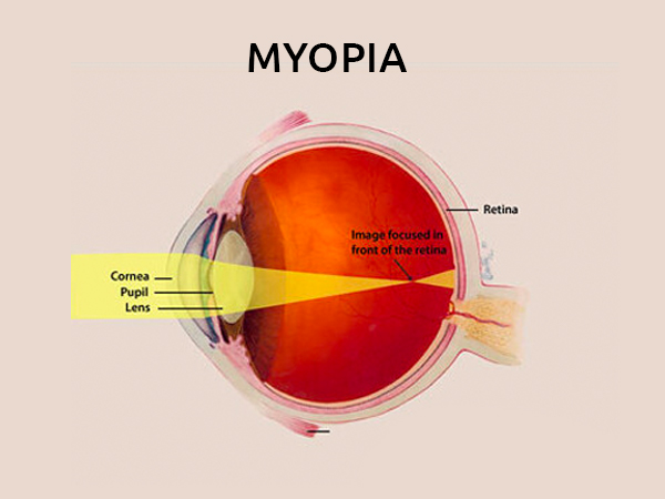 myopia