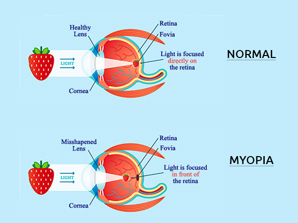 myopia