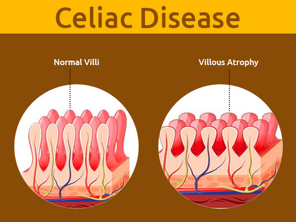 Celiac Disease Celiac Disease