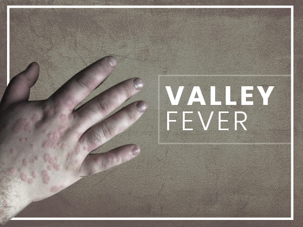 valley fever valley fever