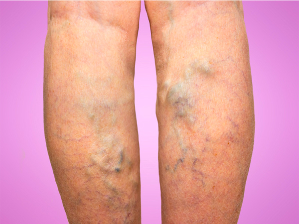 Varicose Veins Varicose Veins
