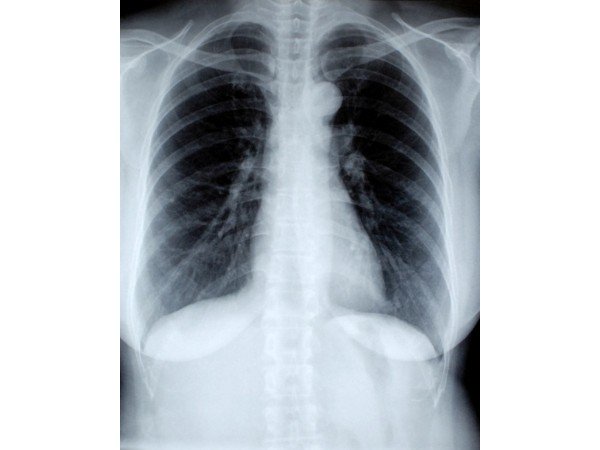Diagnosis Of Walking Pneumonia