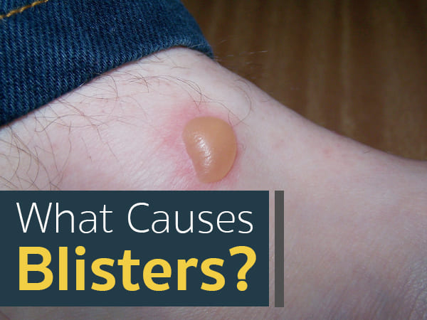 blisters blisters