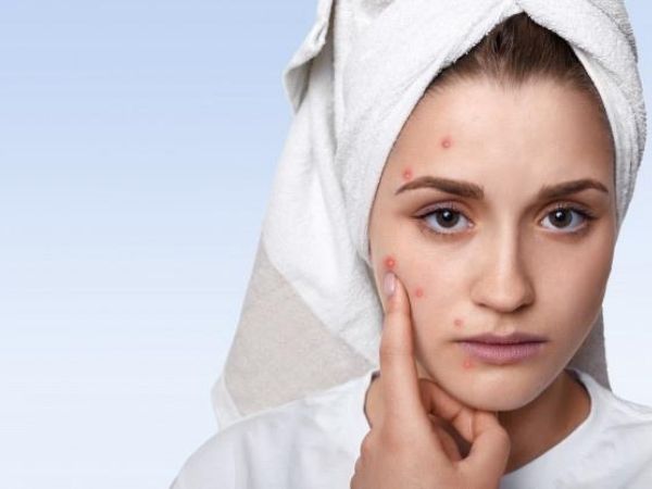 01. Frequent Acne Breakouts