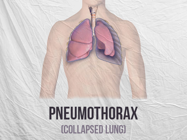 What Is Pneumothorax (Collapsed Lung)? What Is Pneumothorax (Collapsed Lung)?