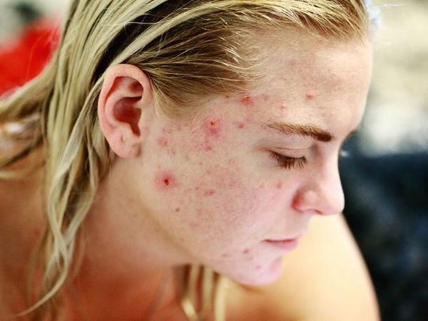 How To Deal With Sudden Acne Breakout How To Deal With Sudden Acne Breakout