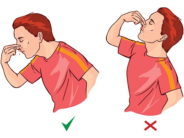 2. Don’t lean backwards during a nose bleed