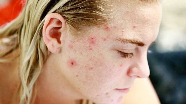 What Are The Symptoms Of High Testosterone In Females?