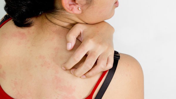 What Clothing Triggers Eczema Flare-ups? What Clothing Triggers Eczema Flare-ups?
