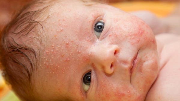 Foods To Avoid In Children With Eczema