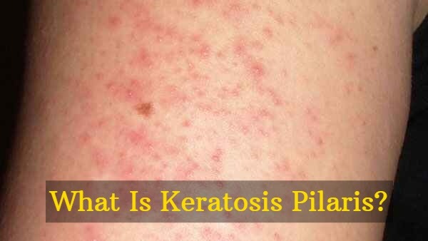 Yami Gautam Opens Up About Her Skin Condition Keratosis Pilaris: Causes, Symptoms And Treatments Yami Gautam Opens Up About Her Skin Condition Keratosis Pilaris: Causes, Symptoms And Treatments