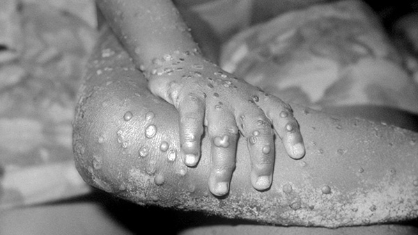 Monkeypox Virus Case In UK