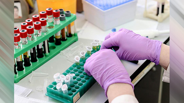 RT-PCR Test For Ankylosing Spondylitis