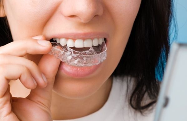 What Are Teeth Aligners? Benefits, Risks And Who Should Get It