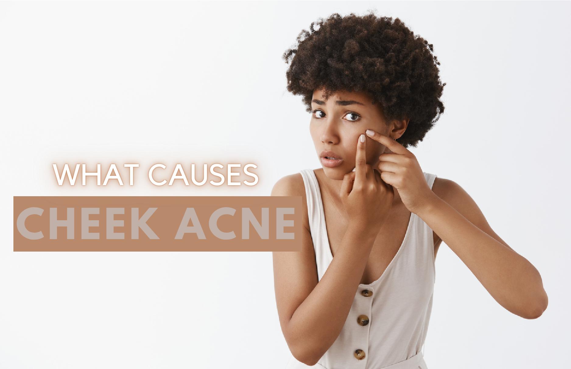 Got Cheek Acne? Here's How You Can Manage It