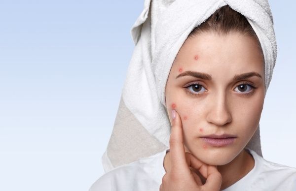 Four Mistakes To Avoid If You Have Acne-Prone Oily Skin