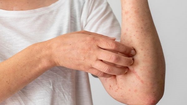 Monkeypox: Kerala Issues Special Alerts Monkeypox: Kerala Issues Special Alerts