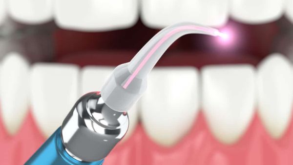 Latest Trends In Root Canal Treatment (RCT)