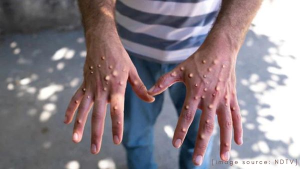asymptomatic-monkeypox-health-complications-vaccine-and-dos-and-donts