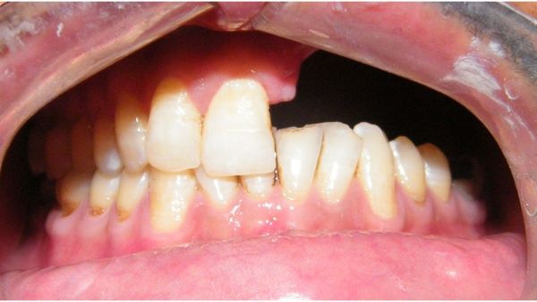 Obturators In Dentistry