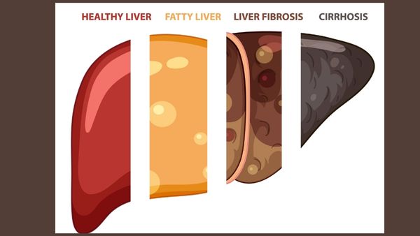 Common Fatty Liver Myths Busted