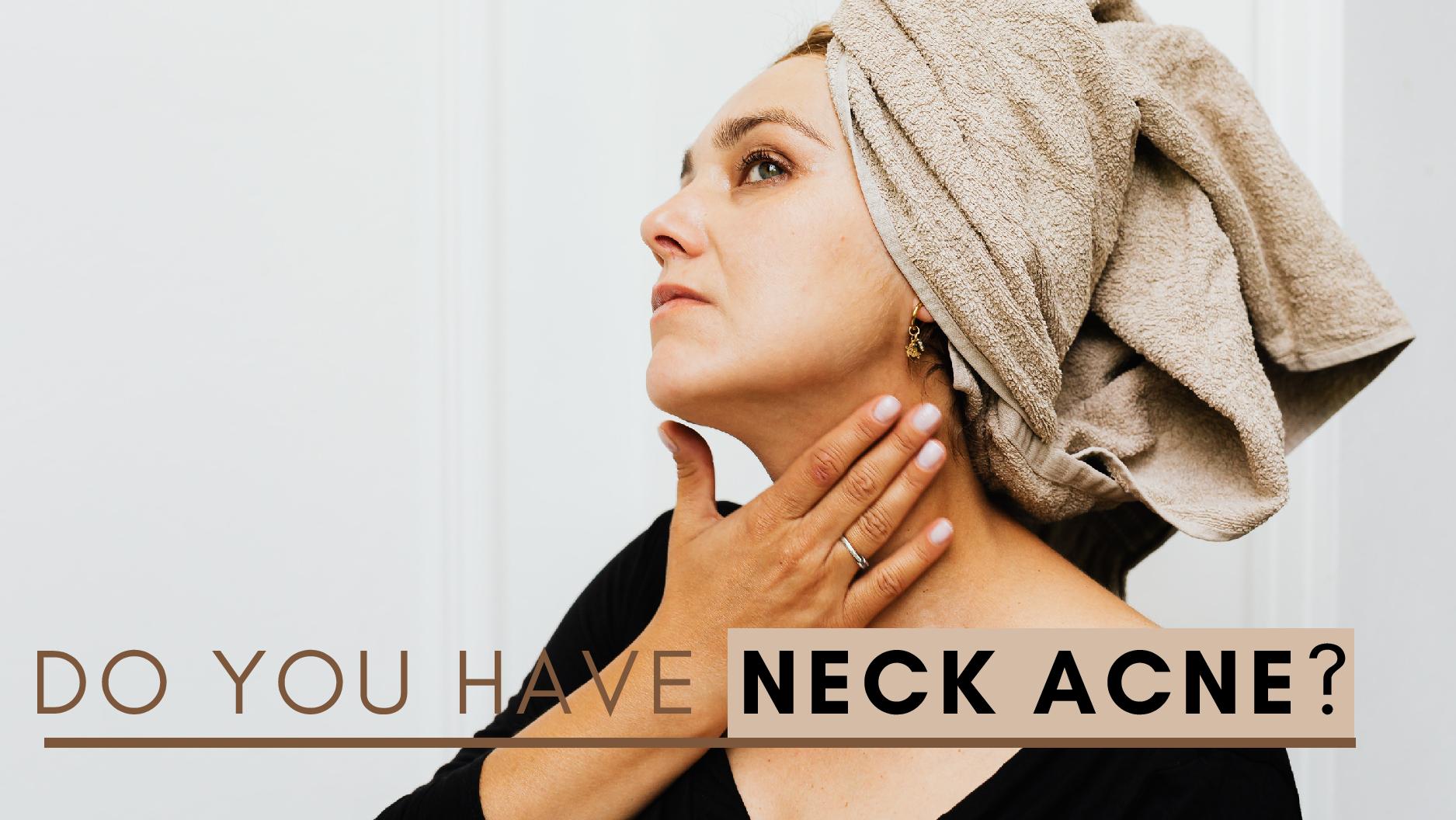 Do You Have Neck Acn Do You Have Neck Acn
