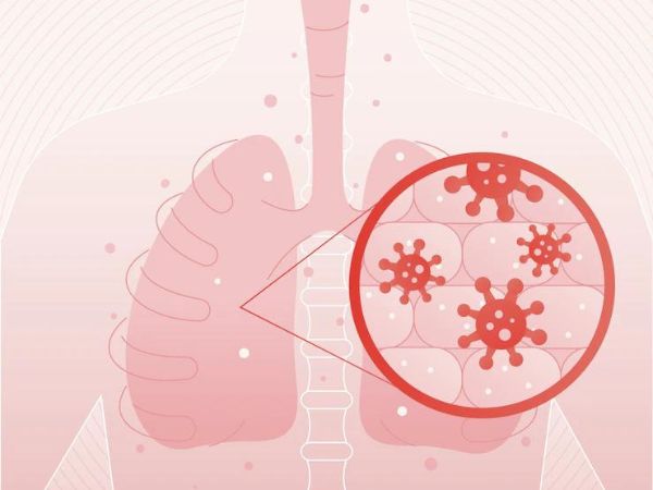 COVID Pneumonia Reappearing
