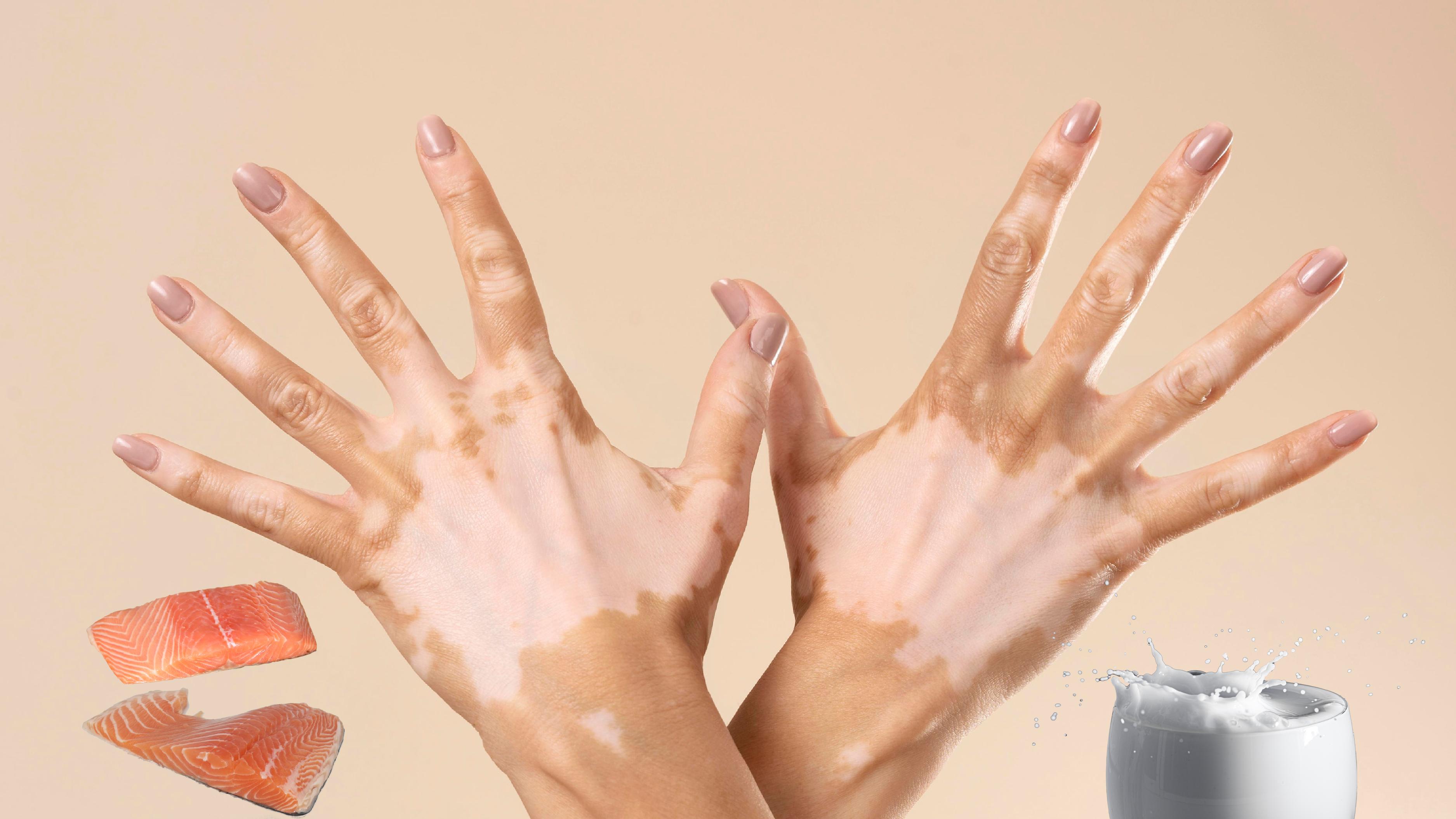 Can Drinking Milk After Eating Fish Cause Skin Diseases?