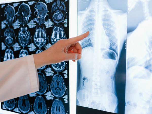 Mesothelial Cancer Mesothelial Cancer