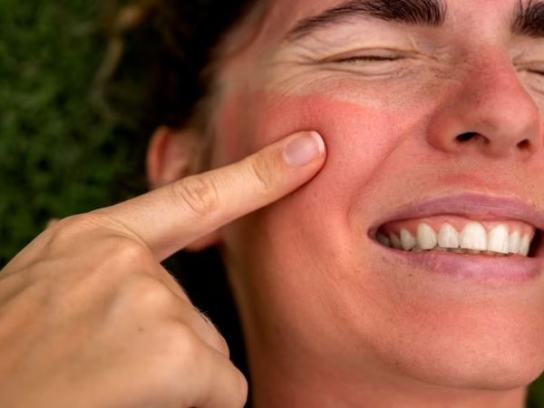 Home Remedies For Sunburn