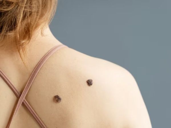 Get Rid Of Moles Fast! My Apple Cider Vinegar Recipe Is Life Changing! - zkvoj4r