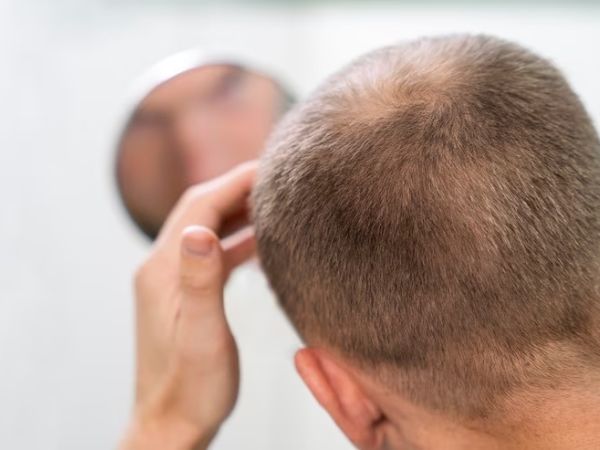 Haircare: Tips For Balding Men