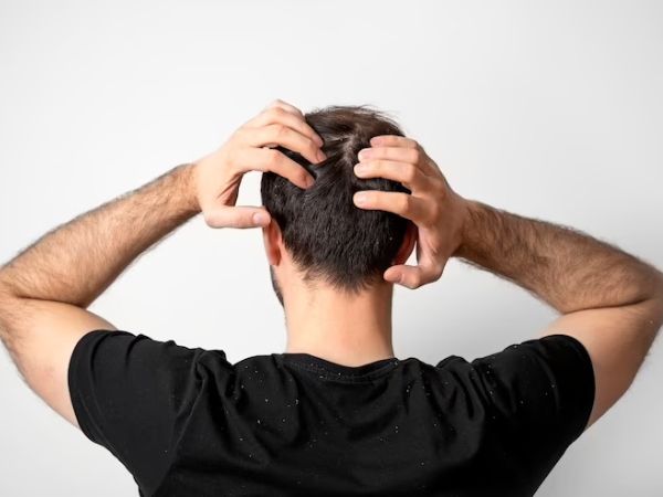 Haircare: Tips For Balding Men