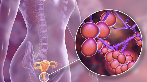 Treating Vaginal Infections