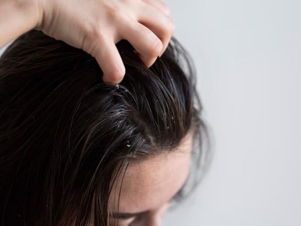 Ways To Protect Your Hair From Lice Ways To Protect Your Hair From Lice