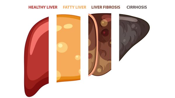 Japanese Diet To For Fatty Liver Disease
