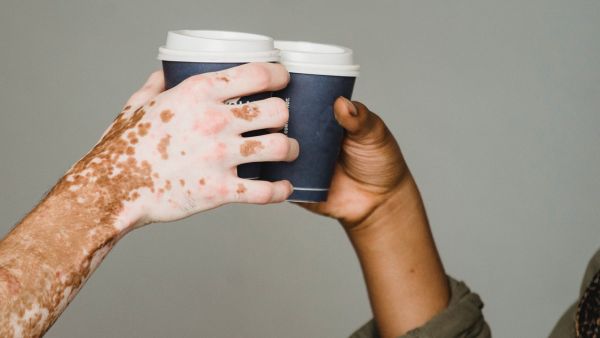 Are You At Risk Of Developing Vitiligo?