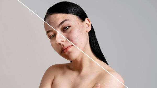 Acne Treatment W Saffron, Tulsi & Aloe