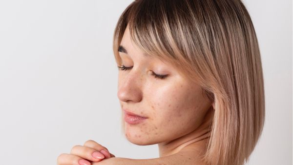 Remedies For Dark Spots