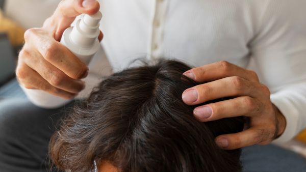 Monsoon Scalp Care Tips