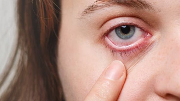 Viral Conjunctivitis On The Rise