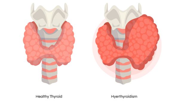 Breastfeeding And Hyperthyroidism