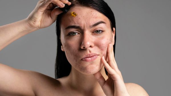  Routine for Acne-Free Skin Routine for Acne-Free Skin