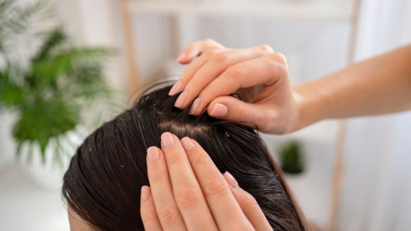 Home Remedies For Forehead Dandruff