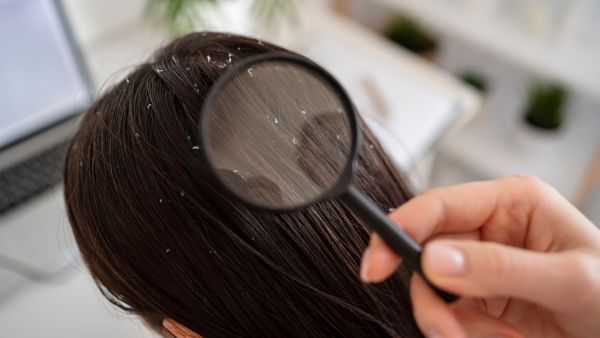 Wash Your Hairbrush If You Have Dandruff