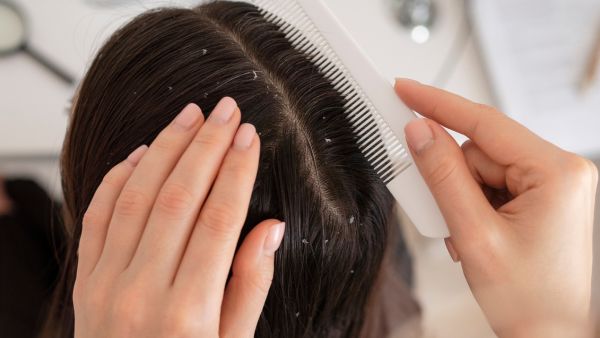 Wash Your Hairbrush If You Have Dandruff