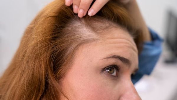 Natural Remedies for Hair Loss